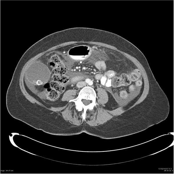 File:Acute pancreatitis (Radiopaedia 19136-19117 Axial C+ portal venous phase 25).jpg