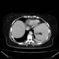 Acute pancreatitis - Balthazar C (Radiopaedia 26569-26714 Axial C+ portal venous phase 19).jpg