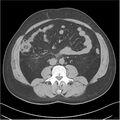 Acute pancreatitis - mild (Radiopaedia 27796-28033 Axial non-contrast 31).jpg
