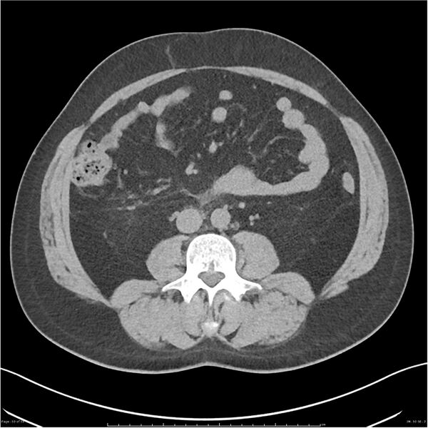 File:Acute pancreatitis - mild (Radiopaedia 27796-28033 Axial non-contrast 31).jpg