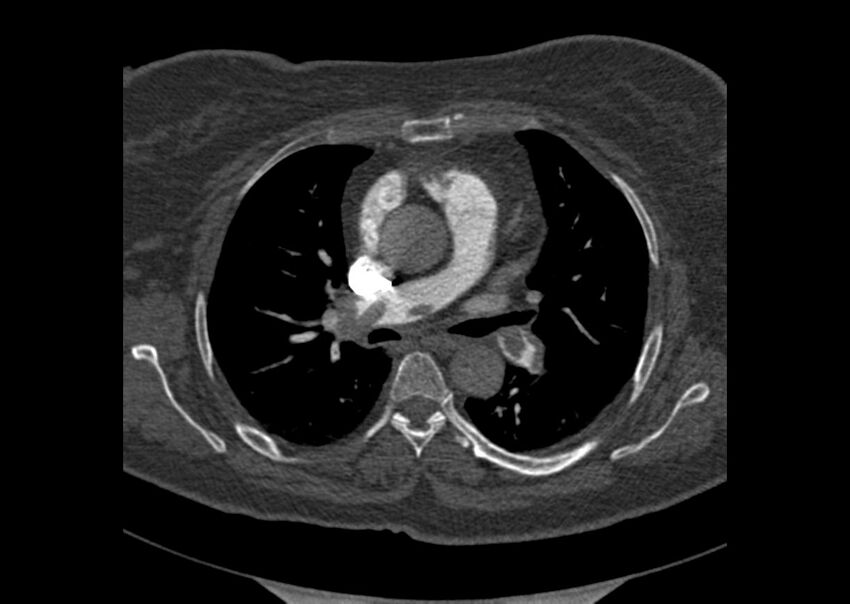Acute pulmonary embolism (Radiopaedia 29938-30466 Axial C+ CTPA 60).jpg
