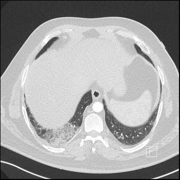 File:Acute pulmonary embolism with pulmonary infarct (Radiopaedia 73062-83768 Axial lung window 20).jpg