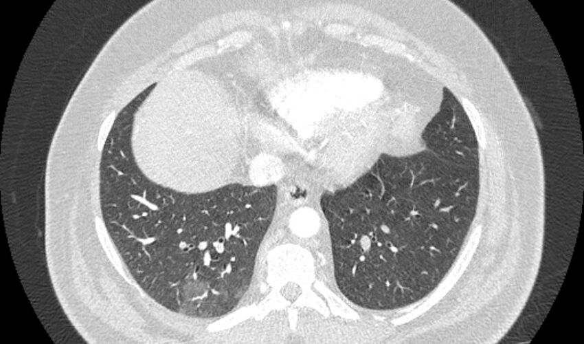 Acute pulmonary embolism with pulmonary infarcts (Radiopaedia 77688-89908 Axial lung window 96).jpg