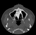 Acute sinusitis (Radiopaedia 23161-23215 Axial bone window 12).jpg