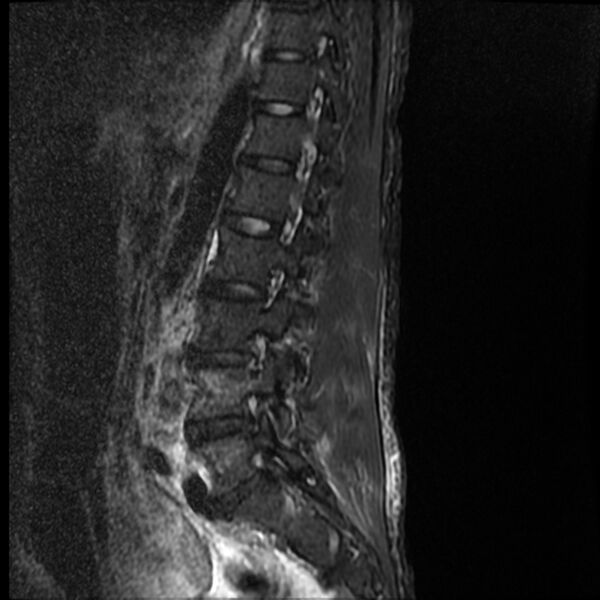 File:Acute vertebral body compression fractures (Radiopaedia 31757-32694 Sagittal STIR 5).jpg
