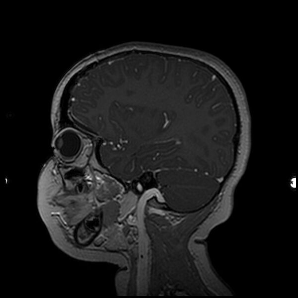 File:Adamantinomatous craniopharyngioma (Radiopaedia 77407-89529 H 86).jpg