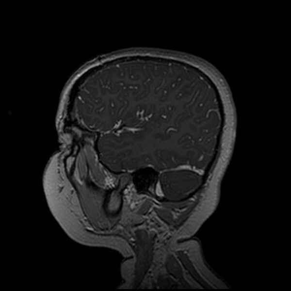 File:Adamantinomatous craniopharyngioma (Radiopaedia 77407-89529 H 96).jpg