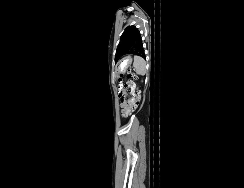 Addison disease (Radiopaedia 49318-54412 Sagittal C+ portal venous phase 10).jpg