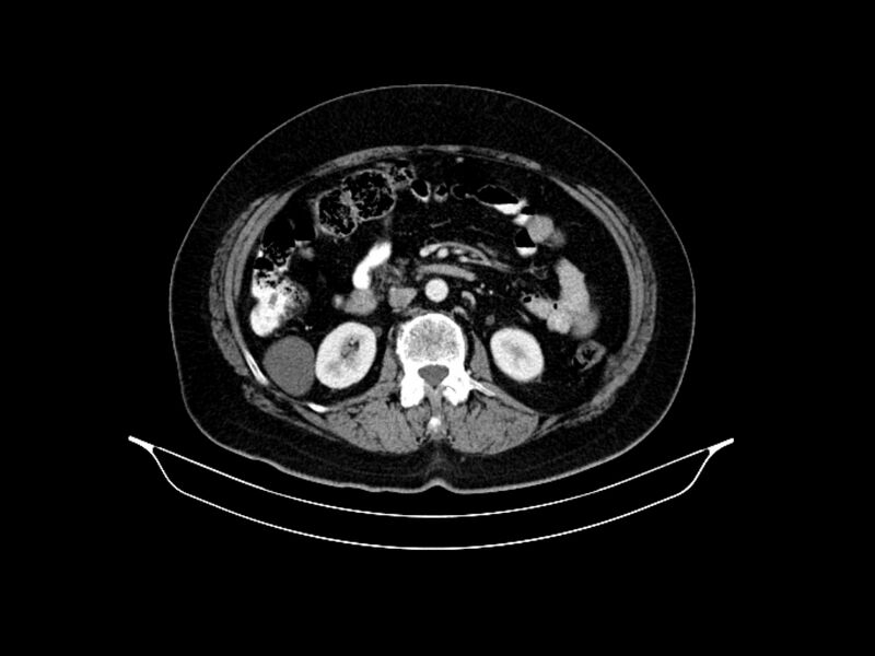 File:Adenocarcinoma of pancreas with hepatic metastasis (Radiopaedia 64332-73122 Axial C+ portal venous phase 48).jpg