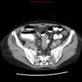 Adenocarcinoma of the colon (Radiopaedia 8191-9039 Axial renal excretory phase 43).jpg