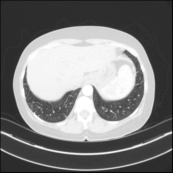 File:Adenocarcinoma of the lung (Radiopaedia 44205-47803 Axial lung window 77).jpg