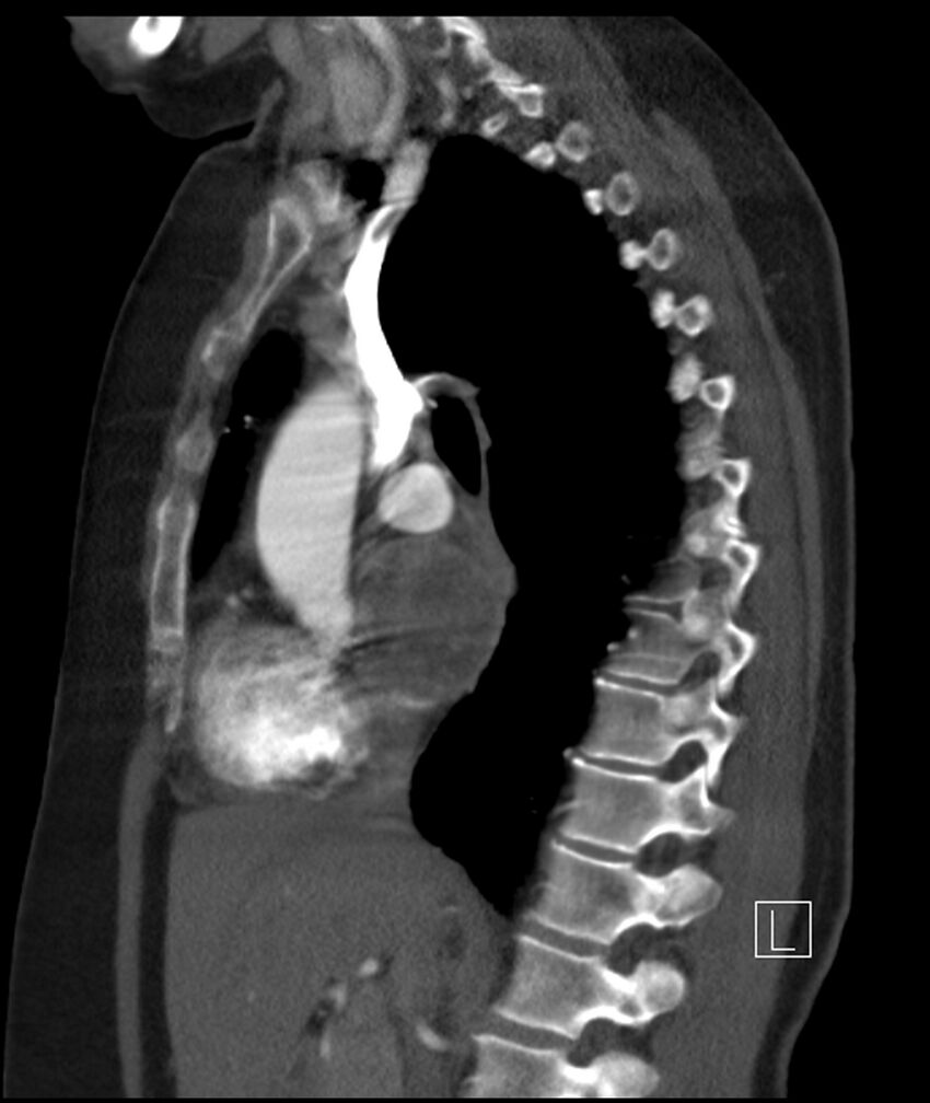 Adenocarcinoma of the lung (Radiopaedia 44205-47803 Sagittal C+ portal venous phase 31).jpg