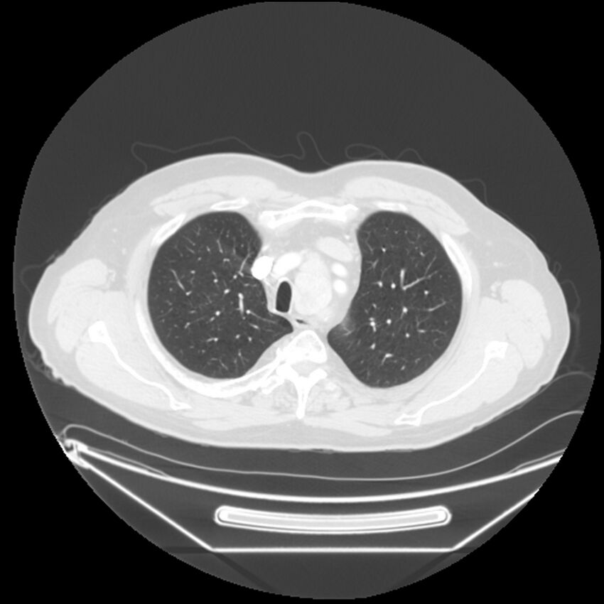 Adenocarcinoma of the lung (Radiopaedia 44876-48759 Axial lung window 16).jpg