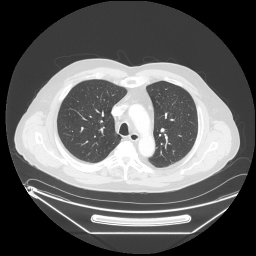 Adenocarcinoma of the lung (Radiopaedia 44876-48759 Axial lung window 23).jpg