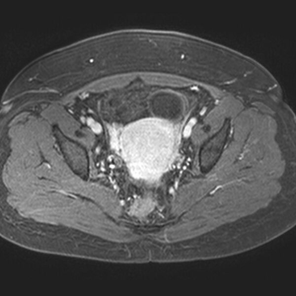 File:Adenomyoma of the uterus (Radiopaedia 9871-10439 Axial T1 C+ fat sat 13).jpg