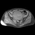Adenomyoma of the uterus (huge) (Radiopaedia 9870-10438 Axial T1 fat sat 19).jpg