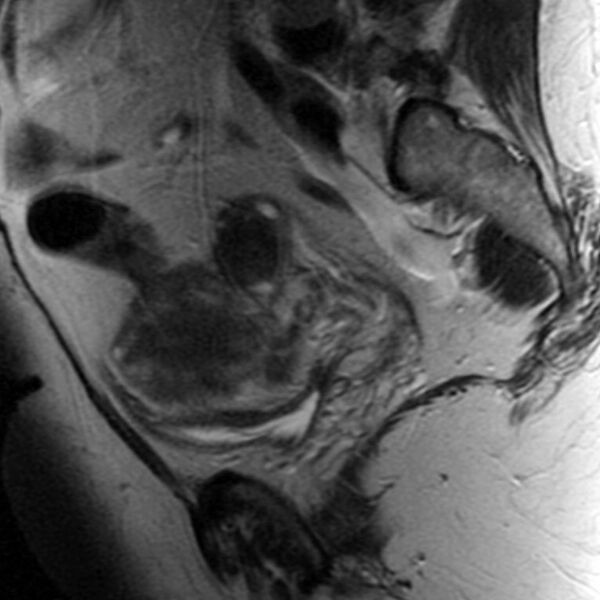 File:Adenomyosis of the uterus (Radiopaedia 9869-10437 Sagittal T2 2).jpg