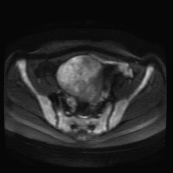 File:Adenomyosis on MRI (Radiopaedia 29328-29780 Axial DWI 4).jpg