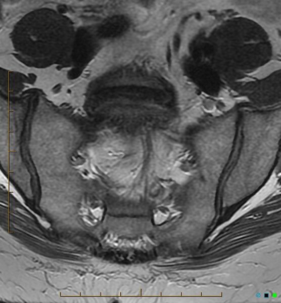 File:Adenomyosis uterus with hematometra (Radiopaedia 45779-50011 Axial T2 1).jpg