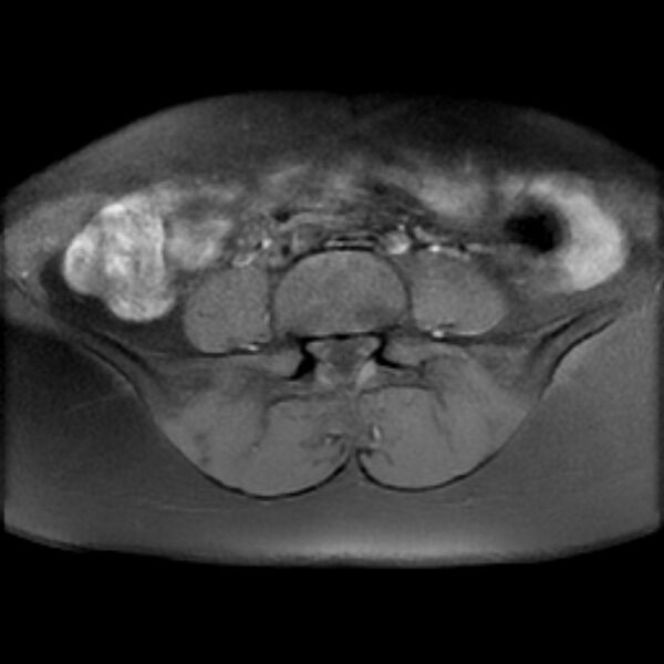 File:Adenomyosis within a septate uterus (Radiopaedia 69963-79981 Axial T1 fat sat 1).jpg