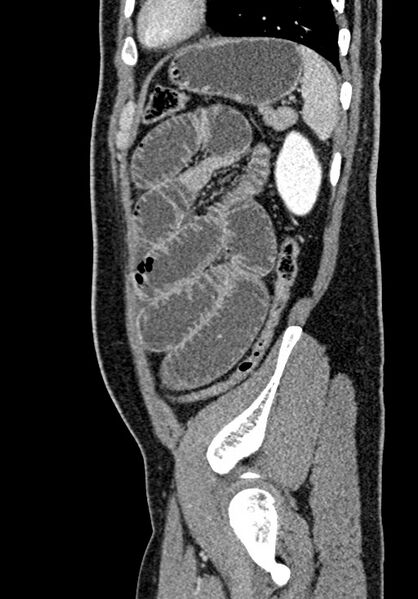 File:Adhesional small bowel obstruction (Radiopaedia 58900-66131 Sagittal C+ portal venous phase 202).jpg
