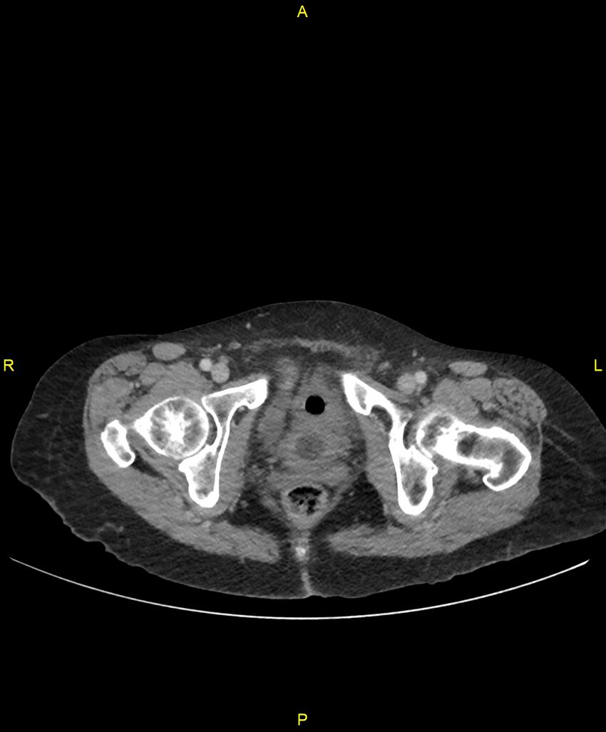 Adhesional small bowel obstruction (Radiopaedia 85402-101024 Axial C+ portal venous phase 281).jpg