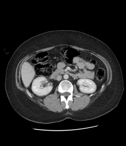 File:Adrenal cortical carcinoma with IVC invasion and thrombosis (Radiopaedia 34307-35597 Axial C+ portal venous phase 39).jpg