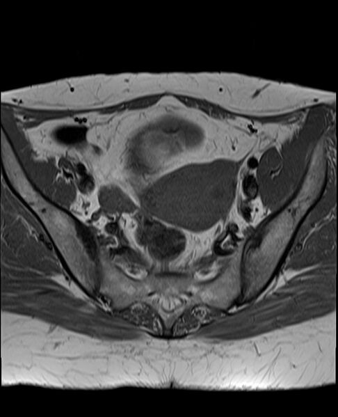 File:Adult granulosa cell tumor of the ovary (Radiopaedia 71581-81950 Axial T1 12).jpg