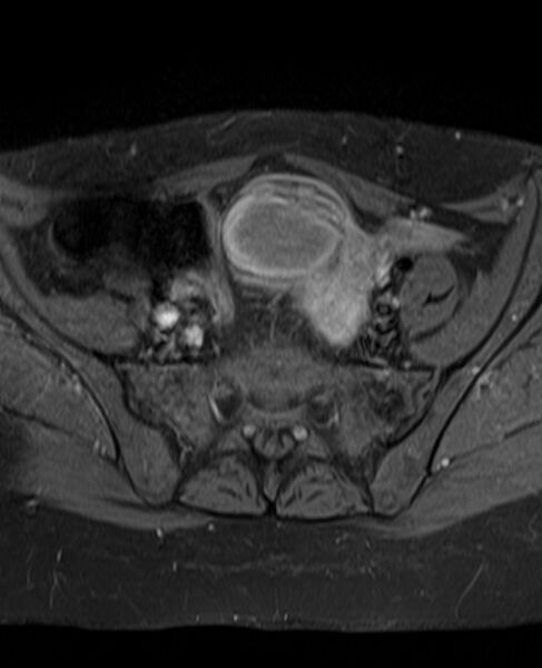File:Adult granulosa cell tumor of the ovary (Radiopaedia 71581-81950 Axial T1 C+ fat sat 9).jpg