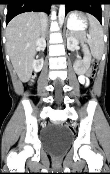 File:Agenesis of the gallbladder (Radiopaedia 55454-61905 Coronal 20).jpg