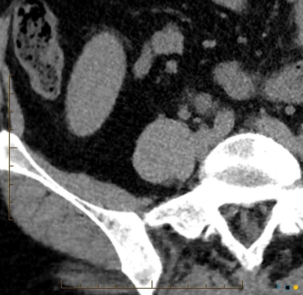 File:Aggressive angiomyolipoma (Radiopaedia 55765-62328 Axial non-contrast 57).jpg