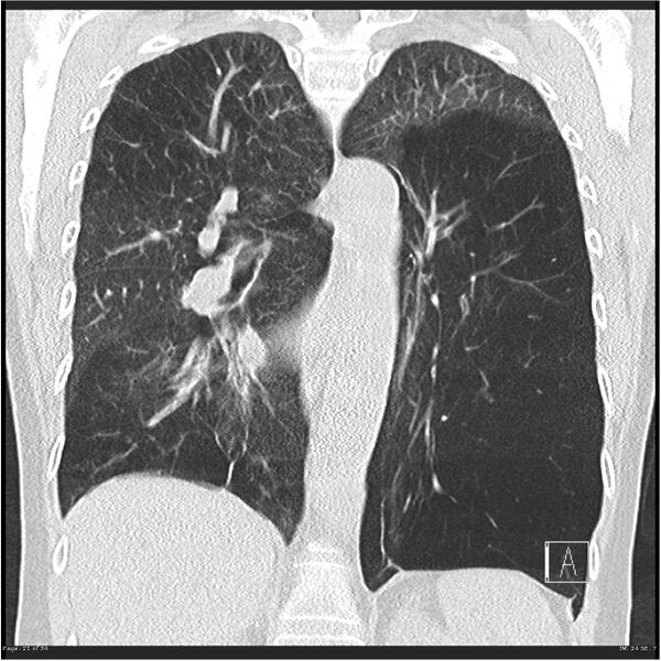 File:Alpha-1-antitrypsin deficiency (Radiopaedia 26537-26678 Coronal lung window 21).jpg