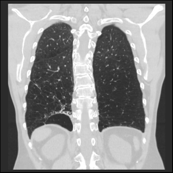 File:Alpha-1-antitrypsin deficiency (Radiopaedia 40993-43722 Coronal lung window 83).jpg