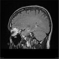 Amnestic syndrome secondary to hypoxic brain injury (Radiopaedia 24743-25004 D 1).jpg