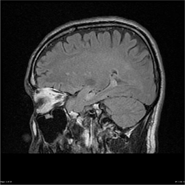 File:Amnestic syndrome secondary to hypoxic brain injury (Radiopaedia 24743-25004 D 1).jpg