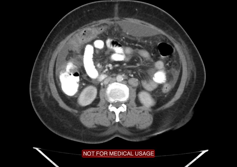 File:Amoebic enterocolitis with liver abscess (Radiopaedia 35100-36609 A 41).jpg