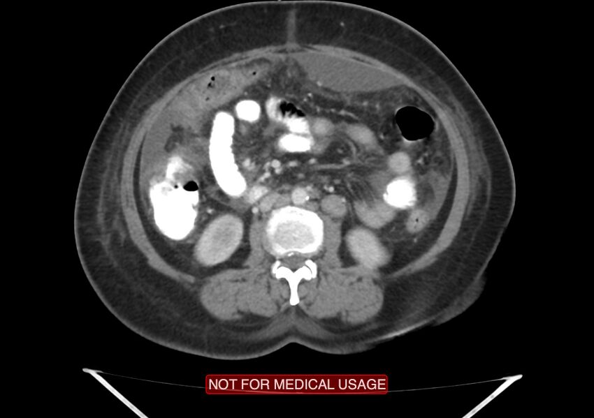 Amoebic enterocolitis with liver abscess (Radiopaedia 35100-36609 A 41).jpg