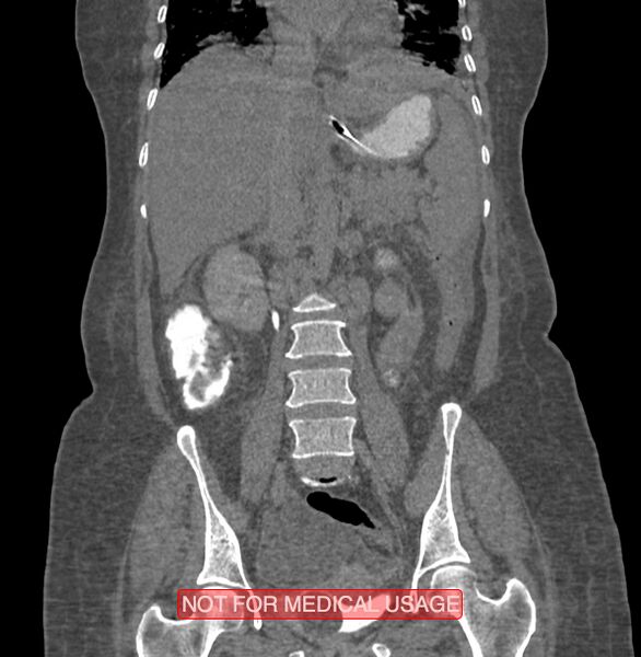 File:Amoebic enterocolitis with liver abscess (Radiopaedia 35100-36609 B 114).jpg
