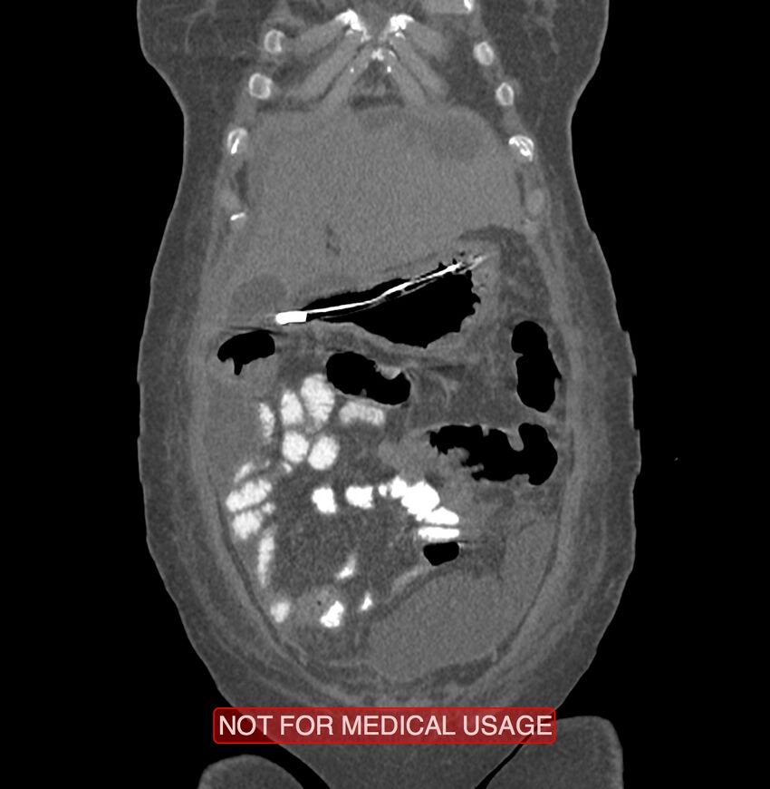 Amoebic enterocolitis with liver abscess (Radiopaedia 35100-36609 B 22).jpg