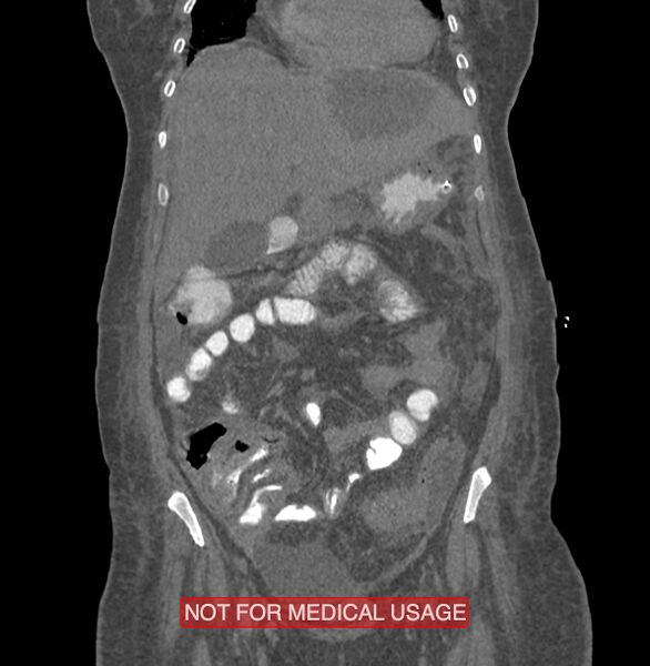 File:Amoebic enterocolitis with liver abscess (Radiopaedia 35100-36609 B 56).jpg
