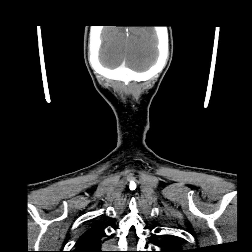 Anaplastic thyroid carcinoma (Radiopaedia 79087-92034 A 107).jpg