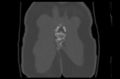 Aneurysmal bone cyst of ischium (Radiopaedia 25957-26094 Coronal bone window 45).png