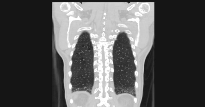 File:Angioinvasive aspergellosis (Radiopaedia 66995-76315 Coronal lung window 54).jpg