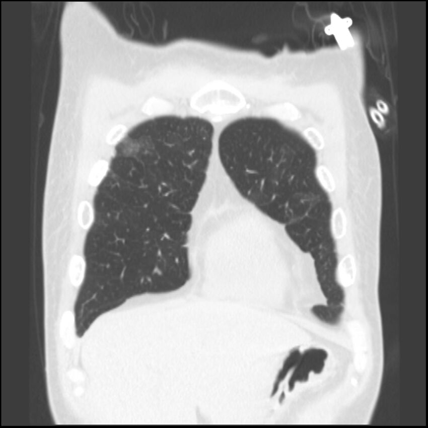 Angioinvasive aspergillosis (Radiopaedia 43957-47466 Coronal lung window 77).jpg