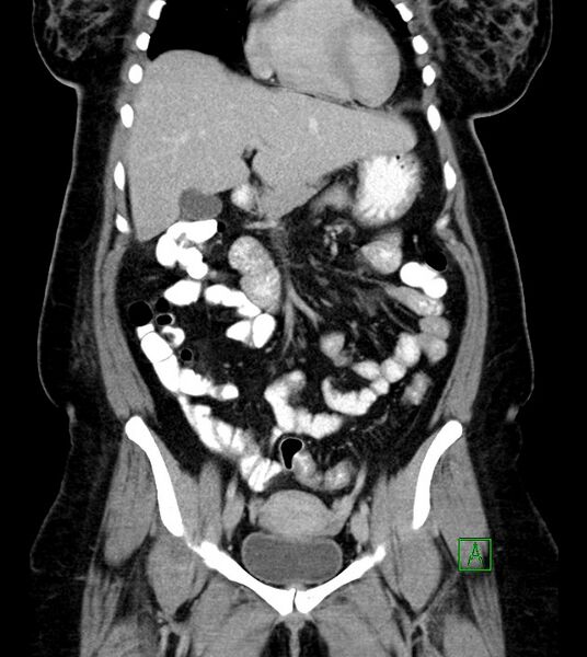 File:Anterior abdominal wall CSF pseudocyst (CSFoma) (Radiopaedia 79453-92571 B 23).jpg