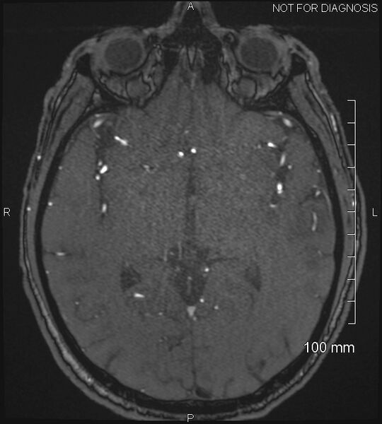 File:Anterior cerebral artery aneurysm (Radiopaedia 80683-94127 Axial MRA 115).jpg