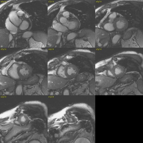 File:Anteroseptal hypokinesia after myocardial infarction (Radiopaedia 15978-15633 E 18).jpg