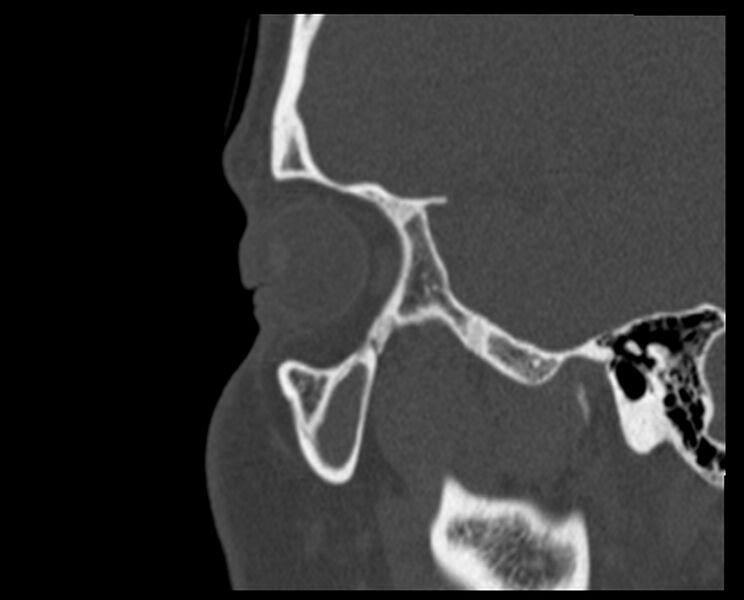 File:Antrochoanal polyp (Radiopaedia 21894-21868 Sagittal bone window 2).jpg
