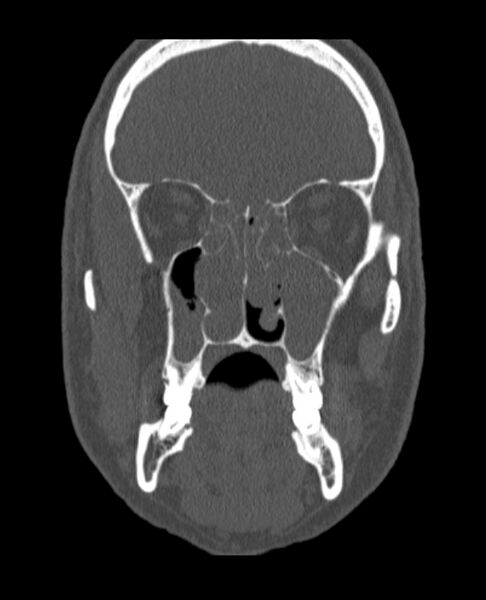 File:Antrochoanal polyp (Radiopaedia 79011-92169 Coronal bone window 45).jpg