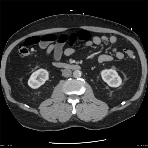 File:Aortic dissection- Stanford A (Radiopaedia 37759-39664 A 104).jpg